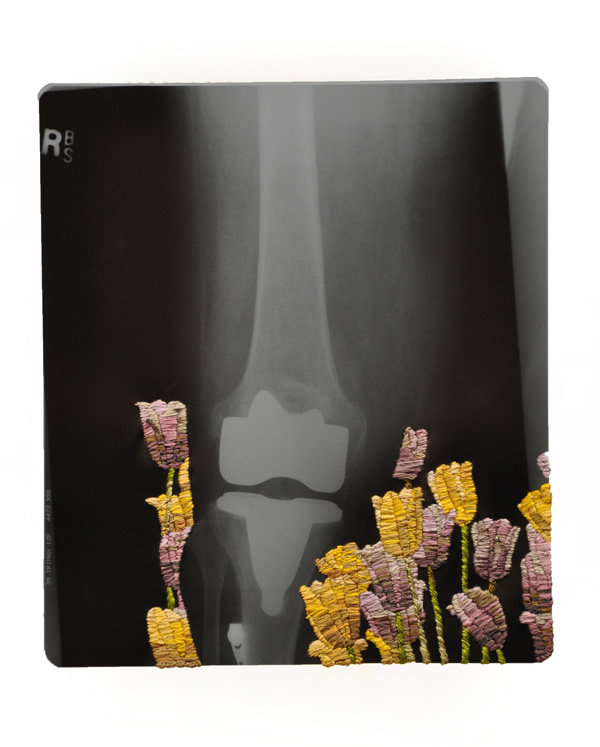 New Knee with Tulips, 11 x 12 1/8", 2010, Hand-embroidered x-ray.